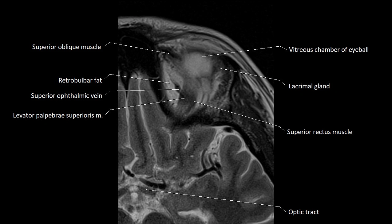 MRI Orbit axial cross sectional anatomy image 12.webp